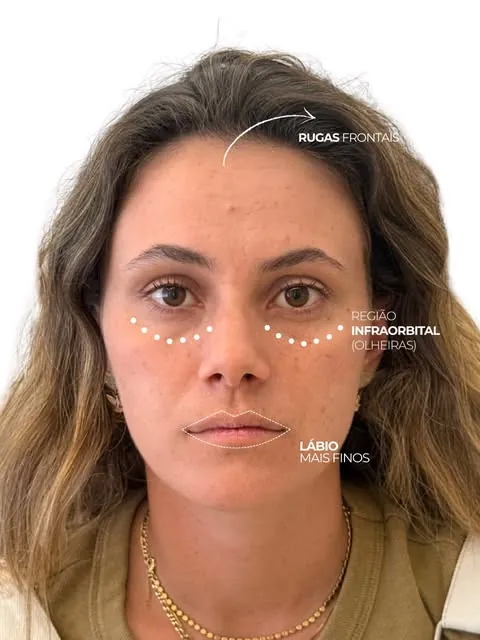Mapeamento facial usado no planejamento individual